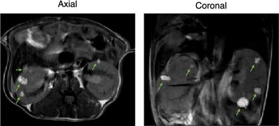 Defining the Magnetic Resonance Features of Renal Lesions and Their Response to Everolimus in a Transgenic Mouse Model of Tuberous Sclerosis Complex